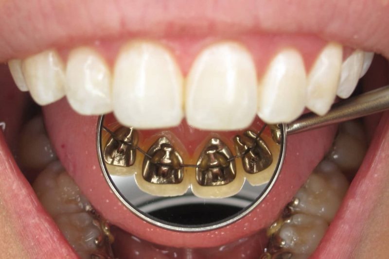 Lingual-ortodonti