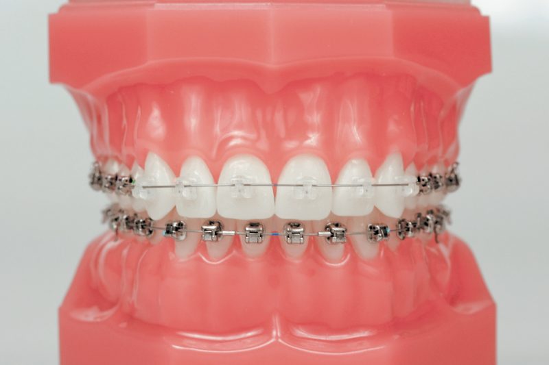 Types of Braces - Zuccala Orthodontics